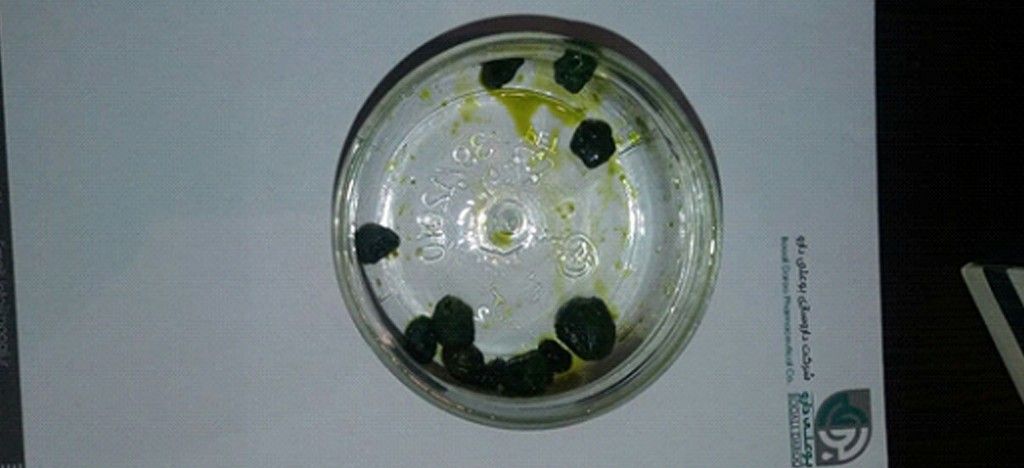 سنگ کیسه صفرا - گزارش موردی درمان - درمان سنگ کیسه صفرا با طب سنتی 