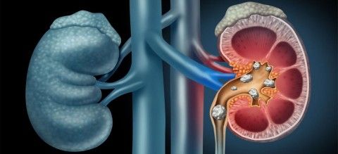 گزارش دو مورد درمان سنگ کلیه در سلامتکده ی طب سنتی بوعلی