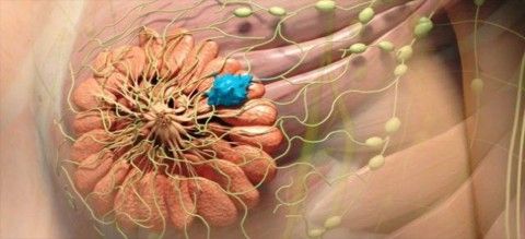 گزارش یک مورد درمان کیست سینه در سلامتکده ی طب سنتی بوعلی